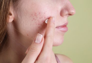 Young,Woman,With,Acne,Problem,Applying,Cosmetic,Product,Onto,Her